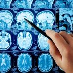 Hand pointing at brain scan images on screen.